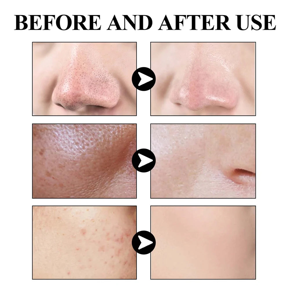 West & Month Remove Cravos, Lama Sólida, Máscara Facial Refrescante, Limpeza da Pele, Hidratante, Controle de Oleosidade, Diminuição dos Poros, Cuidados com a Pele